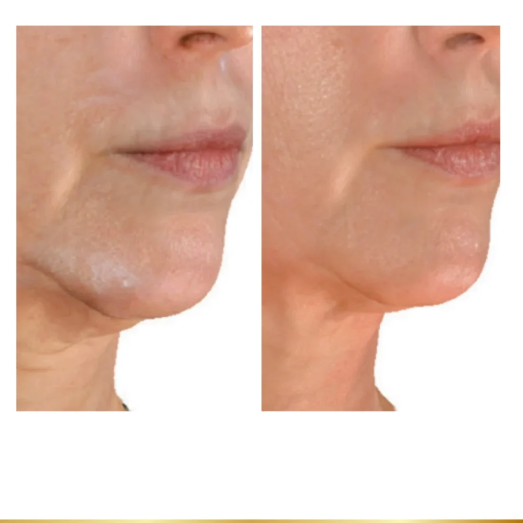 Before and after chin tightening treatment showing smoother, firmer lower face results
