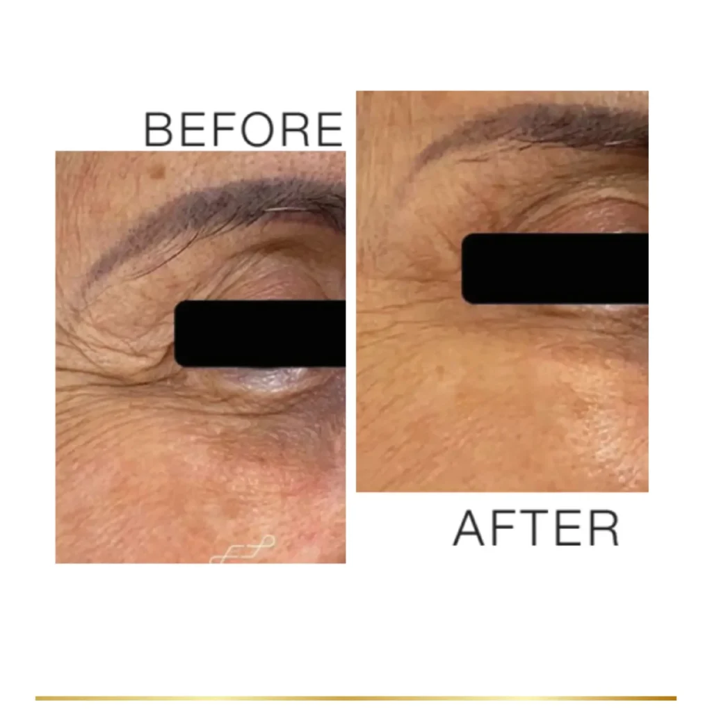 Before and after eye wrinkle reduction showing smoother under-eye area